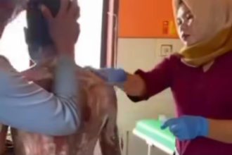 Seorang anak diduga dibakar ibu kandungnya sendiri hanya karena menolak mencari rumput ternak. Foto: Instagram @lagi.viral