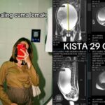 Wanita di Bekasi idap kista ovarium berukuran 29 cm. Foto: Tangkapan layar TikTok @siti.zahro771