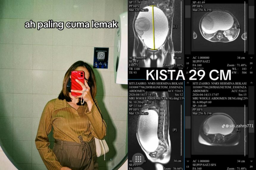 Wanita di Bekasi idap kista ovarium berukuran 29 cm. Foto: Tangkapan layar TikTok @siti.zahro771